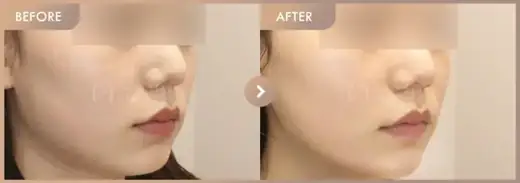 ONDA + Ultherapy 300: before-and-after comparison at Newstar Clinic