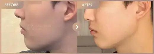 ONDA lifting: before-and-after comparison at Newstar Clinic