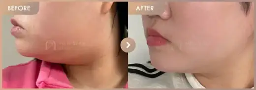 ONDA lifting: before-and-after comparison at Newstar Clinic