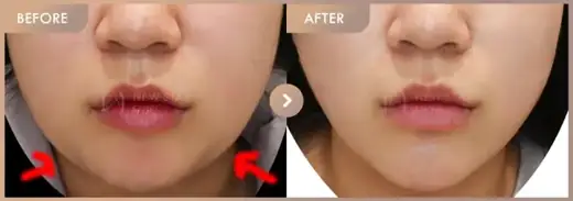 InMode FX + FORMA full-face: before-and-after comparison at Newstar Clinic