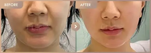 ONDA lifting: before-and-after comparison at Newstar Clinic