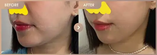 ONDA lifting: before-and-after comparison at Newstar Clinic