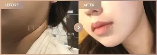 ONDA lifting: before-and-after comparison at Newstar Clinic