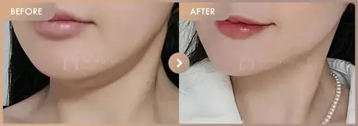 ONDA lifting: before-and-after comparison at Newstar Clinic