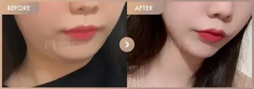 ONDA lifting: before-and-after comparison at Newstar Clinic