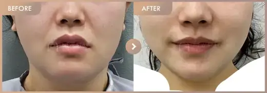 ONDA lifting: before-and-after comparison at Newstar Clinic