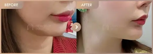 ONDA lifting: before-and-after comparison at Newstar Clinic