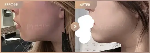 ONDA lifting: before-and-after comparison at Newstar Clinic