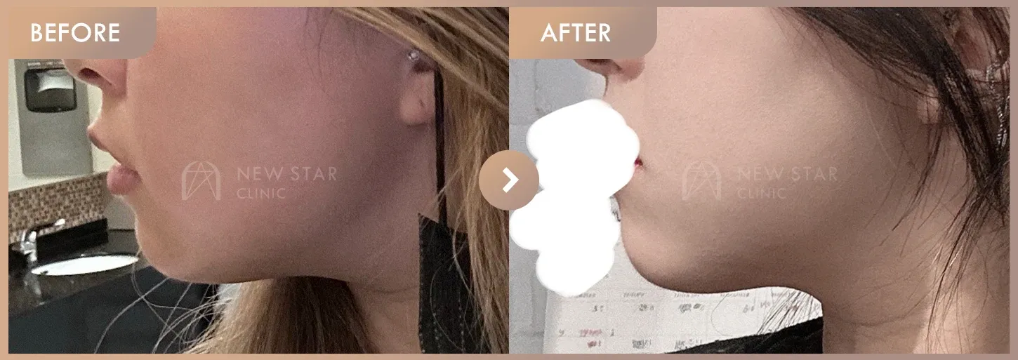 ONDA lifting before-and-after photos at Newstar Clinic