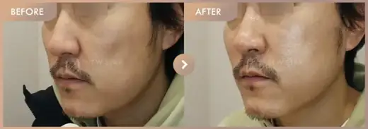 ONDA lifting: before-and-after comparison at Newstar Clinic