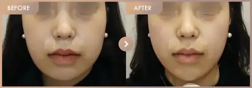 ONDA lifting: before-and-after comparison at Newstar Clinic