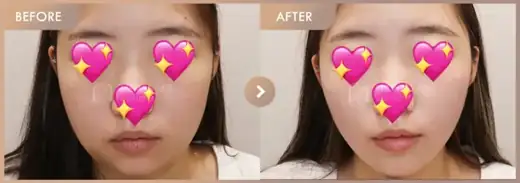 InMode FX + FORMA-full-face · Front view: before-and-after comparison at Newstar Clinic