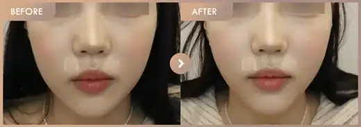 ONDA lifting: before-and-after comparison at Newstar Clinic