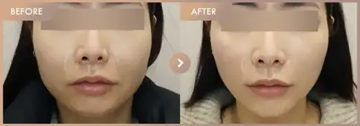 Oligio: before-and-after comparison at Newstar Clinic