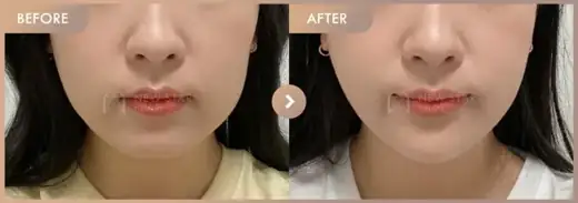 ONDA lifting: before-and-after comparison at Newstar Clinic
