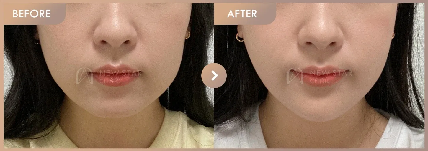 ONDA lifting before-and-after photos at Newstar Clinic