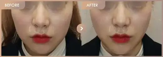ONDA lifting: before-and-after comparison at Newstar Clinic
