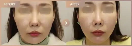 ONDA lifting: before-and-after comparison at Newstar Clinic