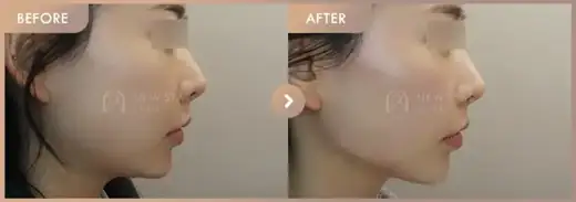 ONDA lifting: before-and-after comparison at Newstar Clinic