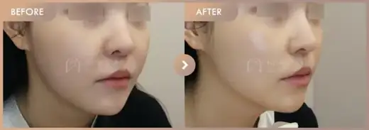 ONDA lifting: before-and-after comparison at Newstar Clinic