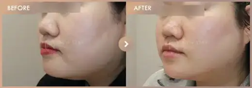 ONDA lifting: before-and-after comparison at Newstar Clinic