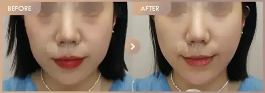 ONDA lifting: before-and-after comparison at Newstar Clinic