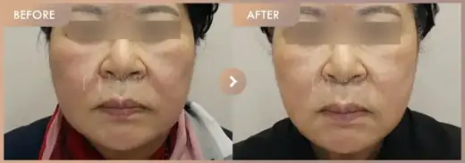 ONDA lifting 3 sessions: before-and-after comparison at Newstar Clinic