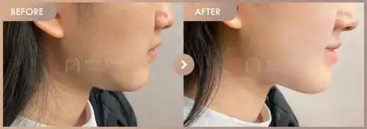 InMode-FX + FORMA-full-face · Side view: before-and-after comparison at Newstar Clinic