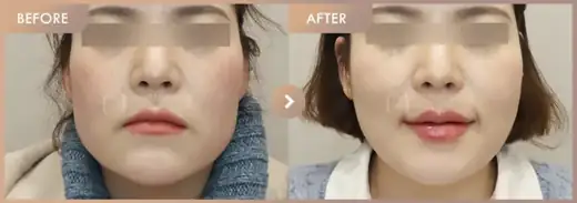 ONDA lifting: before-and-after comparison at Newstar Clinic