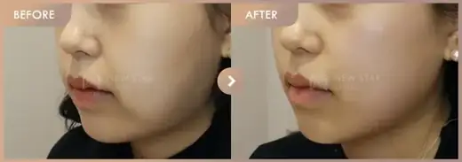 ONDA lifting: before-and-after comparison at Newstar Clinic