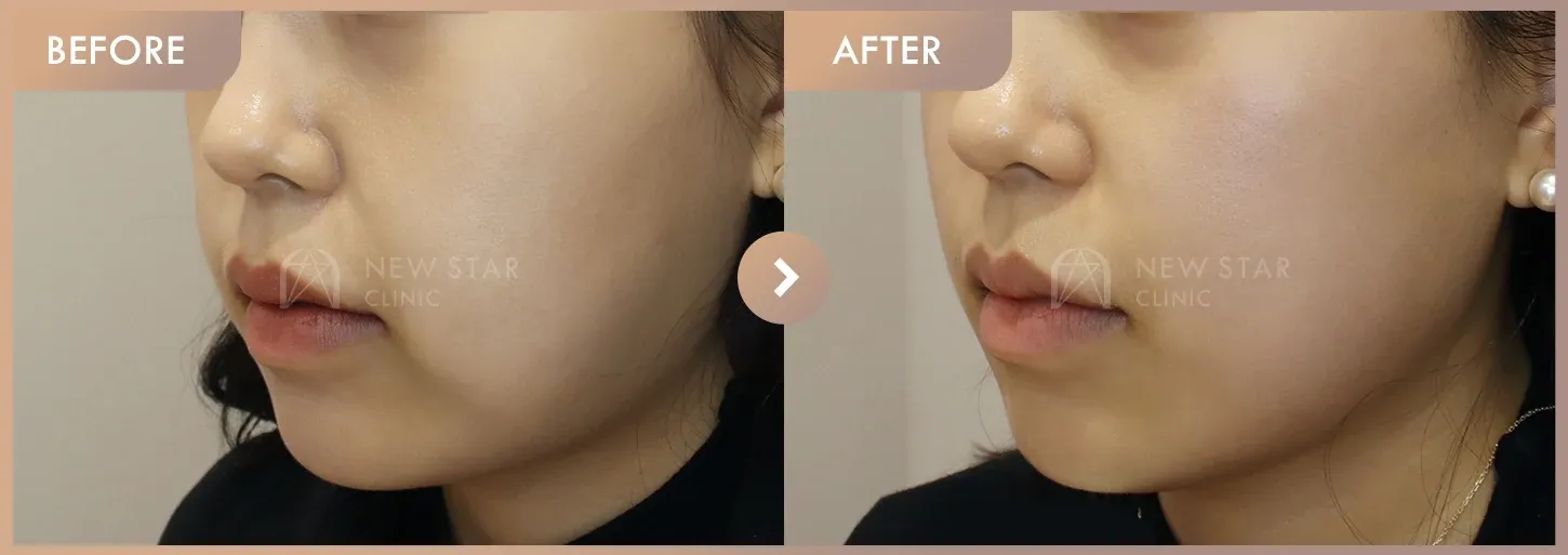 ONDA lifting before-and-after photos at Newstar Clinic