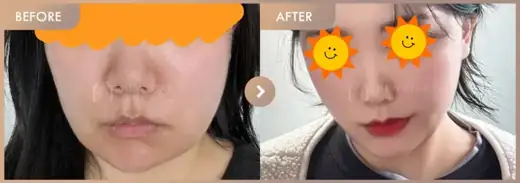 ONDA lifting: before-and-after comparison at Newstar Clinic