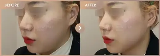 ONDA lifting: before-and-after comparison at Newstar Clinic