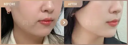 ONDA lifting: before-and-after comparison at Newstar Clinic