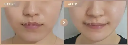 Energy-based lifting: before-and-after comparison at Newstar Clinic