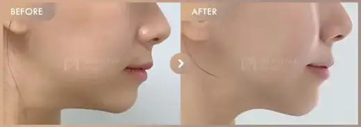 ONDA lifting: before-and-after comparison at Newstar Clinic