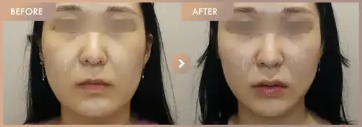 ONDA lifting: before-and-after comparison at Newstar Clinic