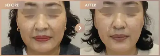 ONDA lifting: before-and-after comparison at Newstar Clinic