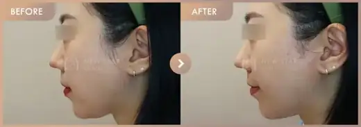 ONDA lifting: before-and-after comparison at Newstar Clinic