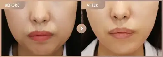 InMode + Ultherapy · Front view: before-and-after comparison at Newstar Clinic