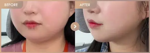 Energy-based lifting: before-and-after comparison at Newstar Clinic