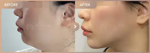 ONDA lifting + Chin filler: before-and-after comparison at Newstar Clinic