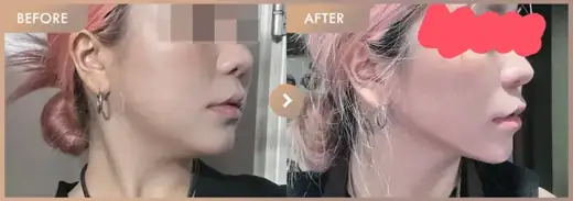 ONDA lifting: before-and-after comparison at Newstar Clinic