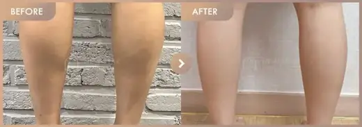 Energy-based lifting: before-and-after comparison at Newstar Clinic