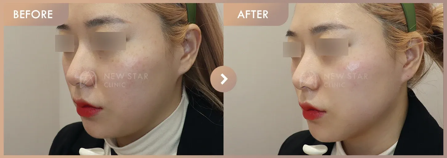 ONDA lifting before-and-after photos at Newstar Clinic