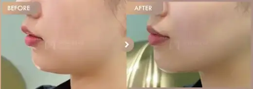 ONDA lifting: before-and-after comparison at Newstar Clinic