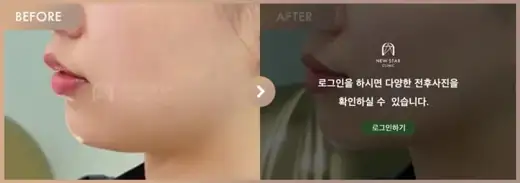 Energy-based lifting: before-and-after comparison at Newstar Clinic