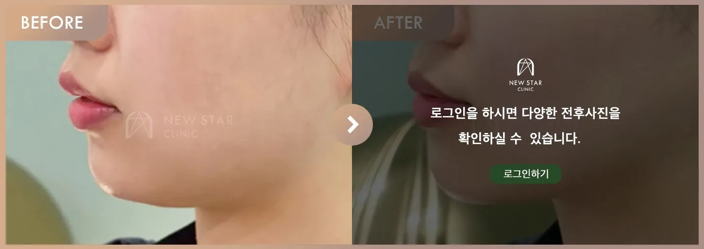 Energy-based lifting before-and-after photos at Newstar Clinic
