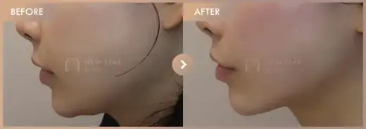 ONDA lifting: before-and-after comparison at Newstar Clinic