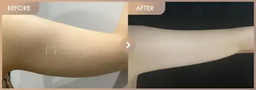 Energy-based lifting: before-and-after comparison at Newstar Clinic